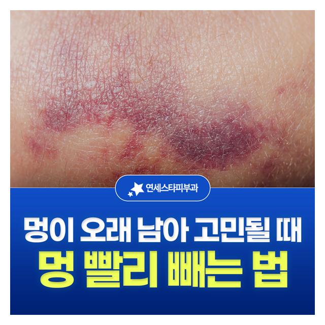 멍 빨리 빼는 법, 멍이 오래 남아 고민될 때 연세스타피부과로 오세요