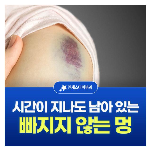 빠지지 않는 멍, 시간이 지나도 남아 있는 멍도 치료 골든타임이 중요합니다