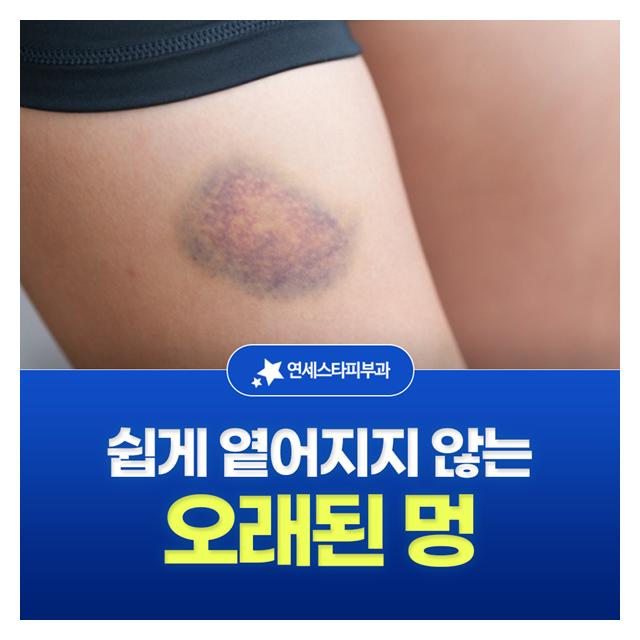 쉽게 옅어지지 않는 오래된 멍도 빠른치료가 중요합니다